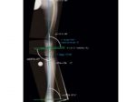 東陽テクニカ、整形外科デジタルプランニングツール「mediCAD」シリーズの新バージョン