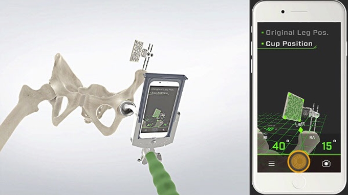 ジンマー・バイオメット、iPhoneを使用した「AR Hip Navigationシステム」