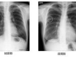 コニカミノルタ、AIで医師の負担軽減に寄与する胸部X線画像診断支援ソフトウェア「CXR finding-i」